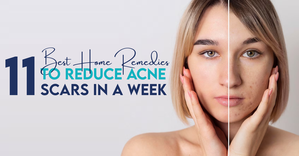 11 Best Home Remedies To Reduce Acne Scars In a Week