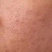 OPEN PORES